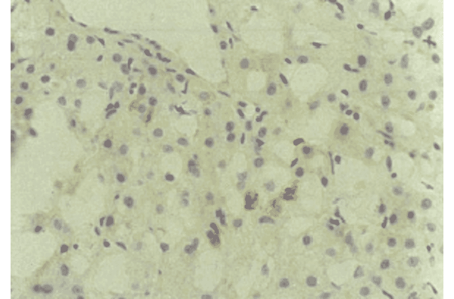 Immunohistochemical detection of HCV core protein.Tissue section from a patient with chronic hepatitis C was immunostained to reveal cells expressing HCV core antigen, which are scattered in the lobules (indirect immunohistochemical method, counterstained with Mayer’s hematoxylin). 