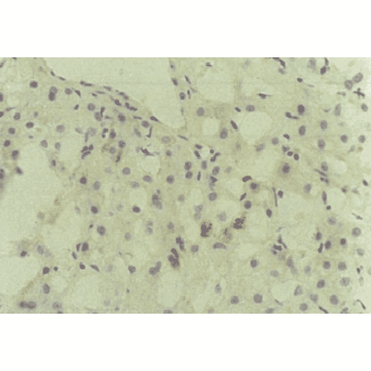 Immunohistochemical detection of HCV core protein.Tissue section from a patient with chronic hepatitis C was immunostained to reveal cells expressing HCV core antigen, which are scattered in the lobules (indirect immunohistochemical method, counterstained with Mayer’s hematoxylin). 