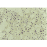 Immunohistochemical detection of HCV core protein.Tissue section from a patient with chronic hepatitis C was immunostained to reveal cells expressing HCV core antigen, which are scattered in the lobules (indirect immunohistochemical method, counterstained with Mayer’s hematoxylin). 