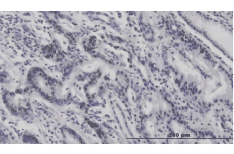 Immunohistochemistry of stomach cancer. Formalin/PFU fixed paraffin-embedded section