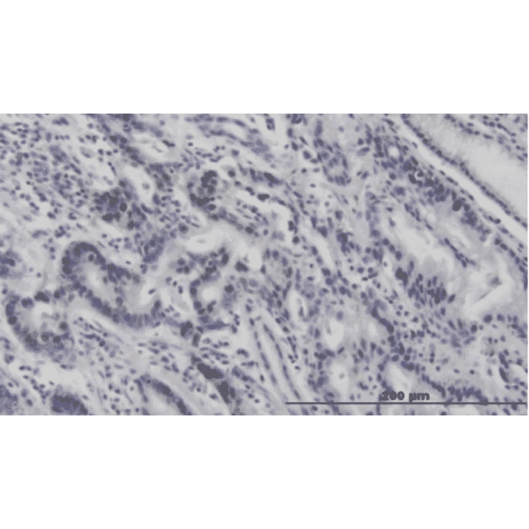 Immunohistochemistry of stomach cancer. Formalin/PFU fixed paraffin-embedded section