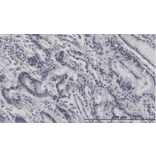 Immunohistochemistry of stomach cancer. Formalin/PFU fixed paraffin-embedded section