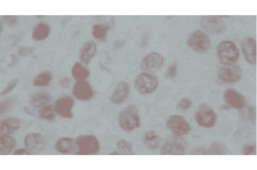Immunohistochemical staining of human prostate cancer tissues with anti-GAK antibody (9-13), showing nuclear accumulation of GAK in cancer cells. The anti-GAK antibody was used at 1/50 dilution.