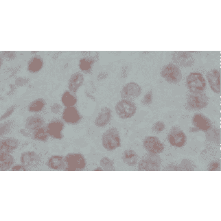 Immunohistochemical staining of human prostate cancer tissues with anti-GAK antibody (9-13), showing nuclear accumulation of GAK in cancer cells. The anti-GAK antibody was used at 1/50 dilution.