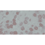 Immunohistochemical staining of human prostate cancer tissues with anti-GAK antibody (9-13), showing nuclear accumulation of GAK in cancer cells. The anti-GAK antibody was used at 1/50 dilution.