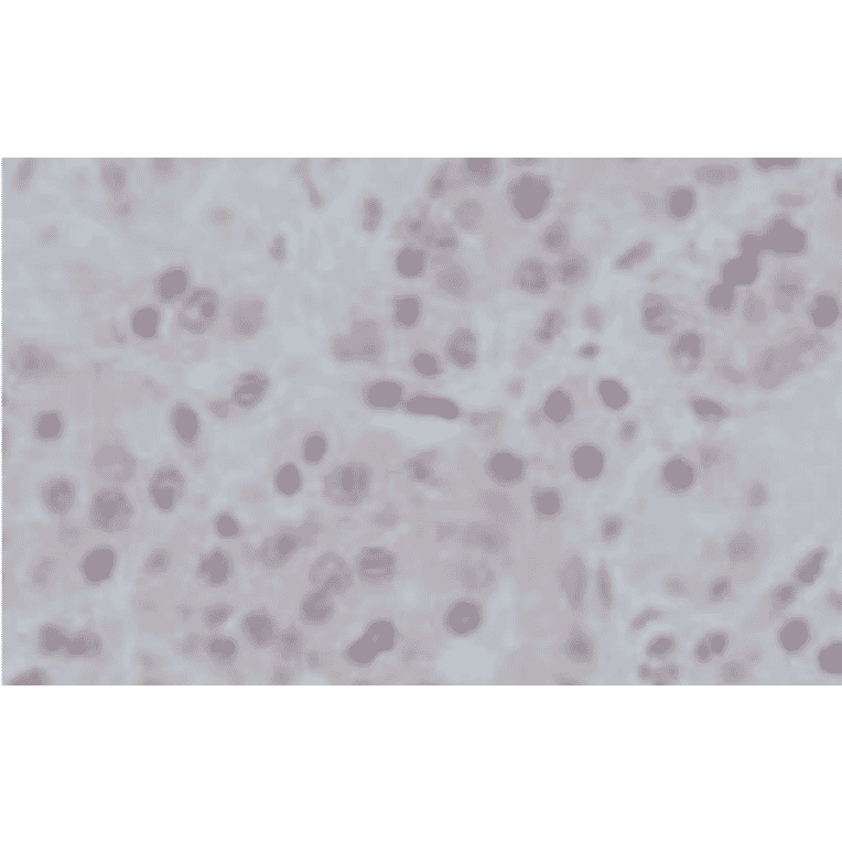 Immunohistochemical staining of human prostate cancer tissues with anti-GAK antibody (9-10), showing nuclear accumulation of GAK in cancer cells. The anti-GAK antibody was used at 1/50 dilution.