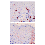 Immunohistochemical stqaining of skin sections from atopic dermatis lesional skin with anti- FceR1a antibodies.