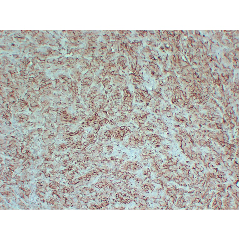 Immunohistochemistry - Anti-PMEL Antibody (V0113) - Antibodies.com