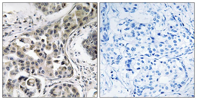Immunohistochemical analysis of paraffin-embedded human breast carcinoma using Anti-USP6NL Antibody. The right hand panel represents a negative control, where the antibody was pre-incubated with the immunising peptide.