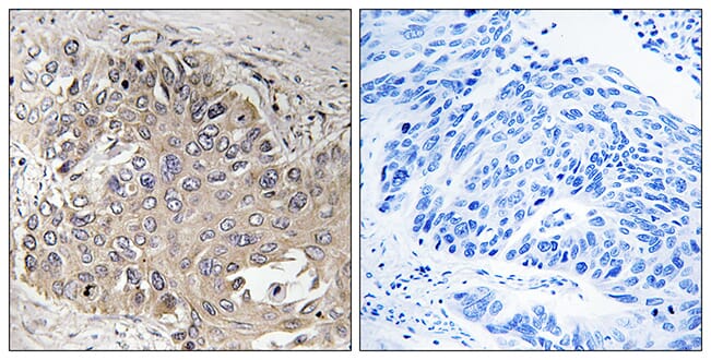 Immunohistochemical analysis of paraffin-embedded human lung carcinoma using Anti-SPTBN5 Antibody. The right hand panel represents a negative control, where the antibody was pre-incubated with the immunising peptide.