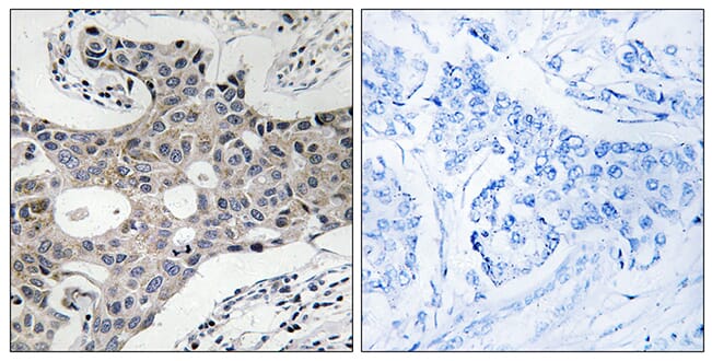Immunohistochemical analysis of paraffin-embedded human breast carcinoma using Anti-SEC16A Antibody. The right hand panel represents a negative control, where the antibody was pre-incubated with the immunising peptide.