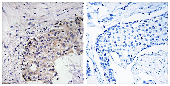 Immunohistochemical analysis of paraffin-embedded human breast carcinoma using Anti-SCARF2 Antibody. The right hand panel represents a negative control, where the antibody was pre-incubated with the immunising peptide.