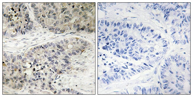 Immunohistochemical analysis of paraffin-embedded human lung carcinoma using Anti-MAPK15 Antibody. The right hand panel represents a negative control, where the antibody was pre-incubated with the immunising peptide.