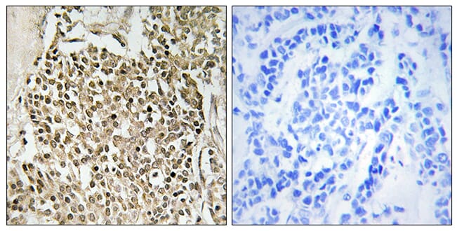 Immunohistochemical analysis of paraffin-embedded human breast carcinoma using Anti-CEP350 Antibody. The right hand panel represents a negative control, where the antibody was pre-incubated with the immunising peptide.