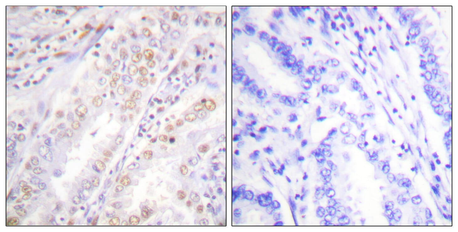 Immunohistochemical analysis of paraffin-embedded human lung carcinoma using Anti-XRCC2 Antibody. The right hand panel represents a negative control, where the antibody was pre-incubated with the immunising peptide.