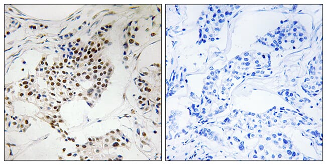 Immunohistochemical analysis of paraffin-embedded human breast carcinoma using Anti-SGOL2 Antibody. The right hand panel represents a negative control, where the antibody was pre-incubated with the immunising peptide.