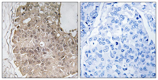 Immunohistochemical analysis of paraffin-embedded human breast carcinoma using Anti-PARP4 Antibody. The right hand panel represents a negative control, where the antibody was pre-incubated with the immunising peptide.