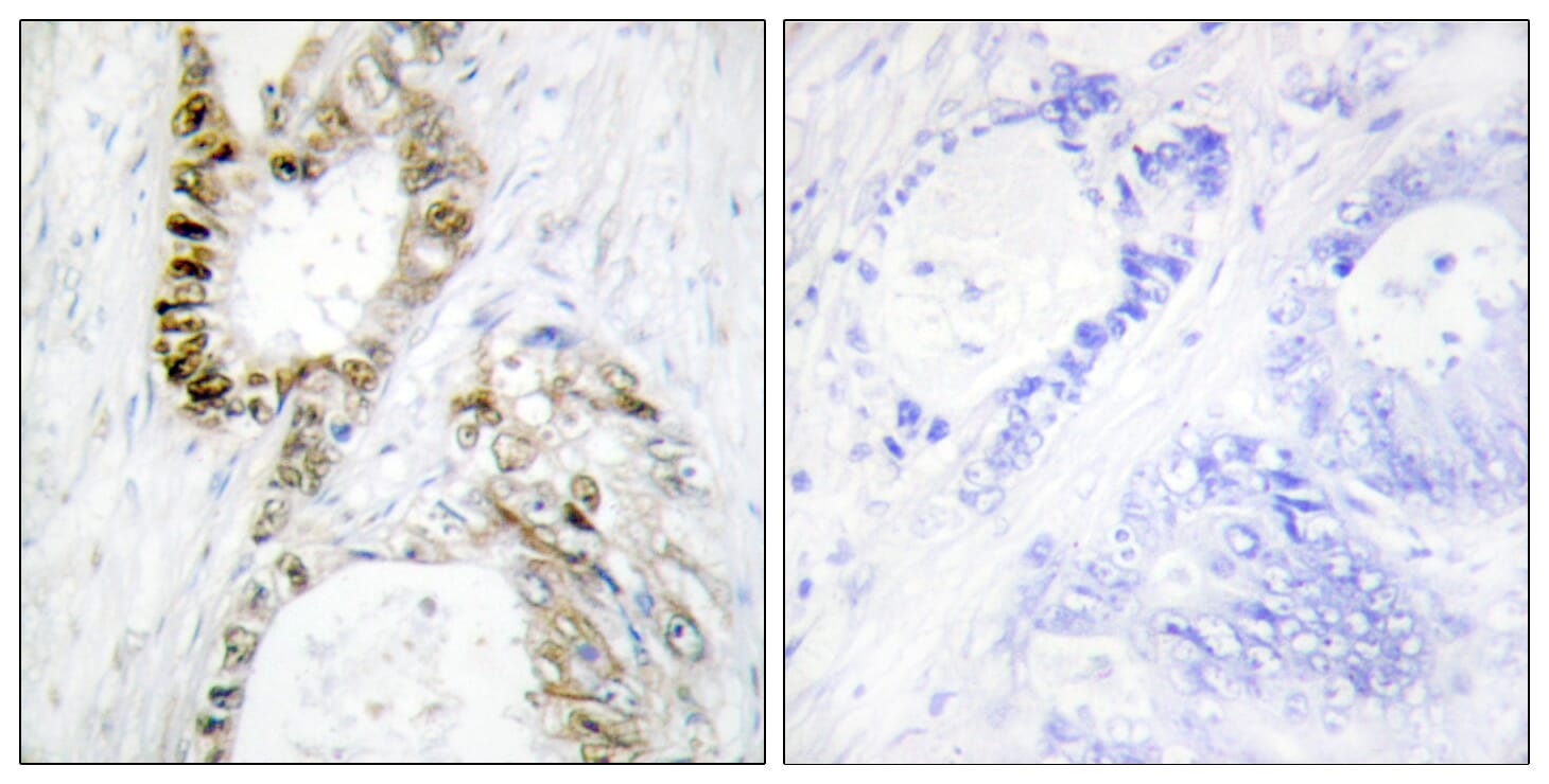 Immunohistochemical analysis of paraffin-embedded human colon carcinoma using Anti-FANCA Antibody. The right hand panel represents a negative control, where the antibody was pre-incubated with the immunising peptide.