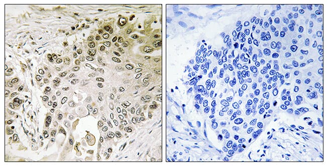 Immunohistochemical analysis of paraffin-embedded human lung carcinoma using Anti-RFX2 Antibody. The right hand panel represents a negative control, where the antibody was pre-incubated with the immunising peptide.