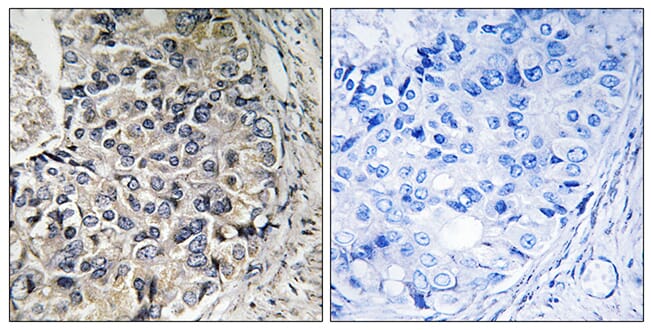 Immunohistochemical analysis of paraffin-embedded human prostate carcinoma tissue using Anti-CMC1 Antibody. The right hand panel represents a negative control, where the antibody was pre-incubated with the immunising peptide.