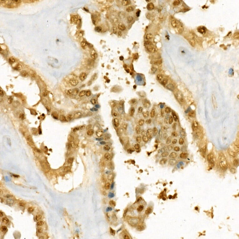 Immunohistochemistry - Anti-Thymidylate Synthase Antibody (A11314) - Antibodies.com