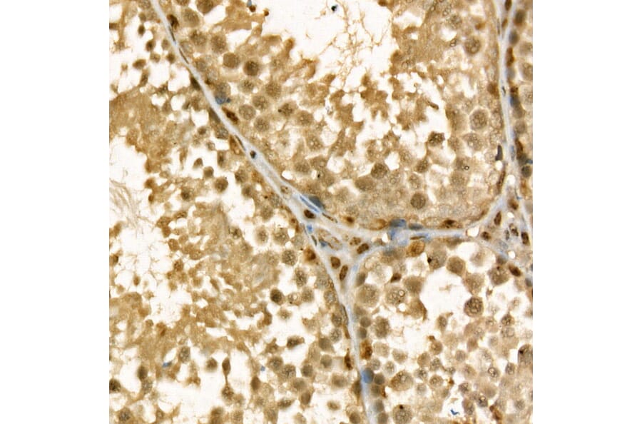 Immunohistochemistry - Anti-Thymidylate Synthase Antibody (A11314) - Antibodies.com