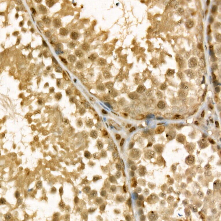 Immunohistochemistry - Anti-Thymidylate Synthase Antibody (A11314) - Antibodies.com