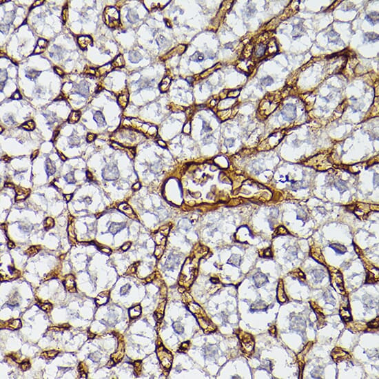Immunohistochemistry of paraffin-embedded human prostate cancer using Anti-APOA1 Antibody (A1129) at dilution of 1:100 (40x lens).