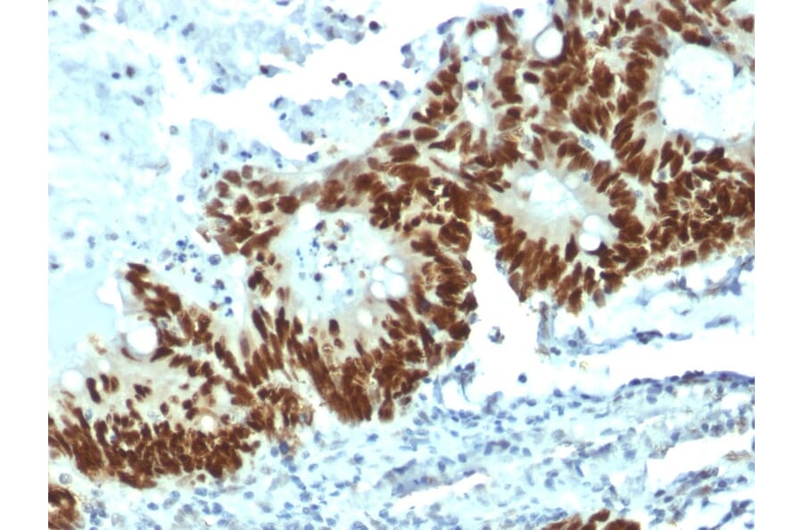Immunohistochemistry - Paraffin - Anti-p53 Antibody [DO-1] (A115696) - Antibodies.com