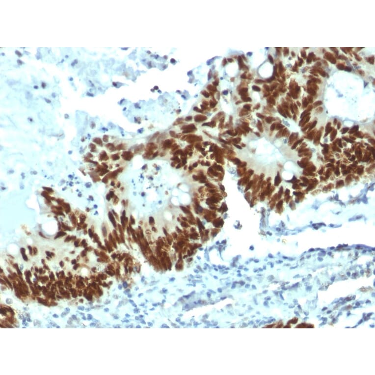 Immunohistochemistry - Paraffin - Anti-p53 Antibody [DO-1] (A115696) - Antibodies.com