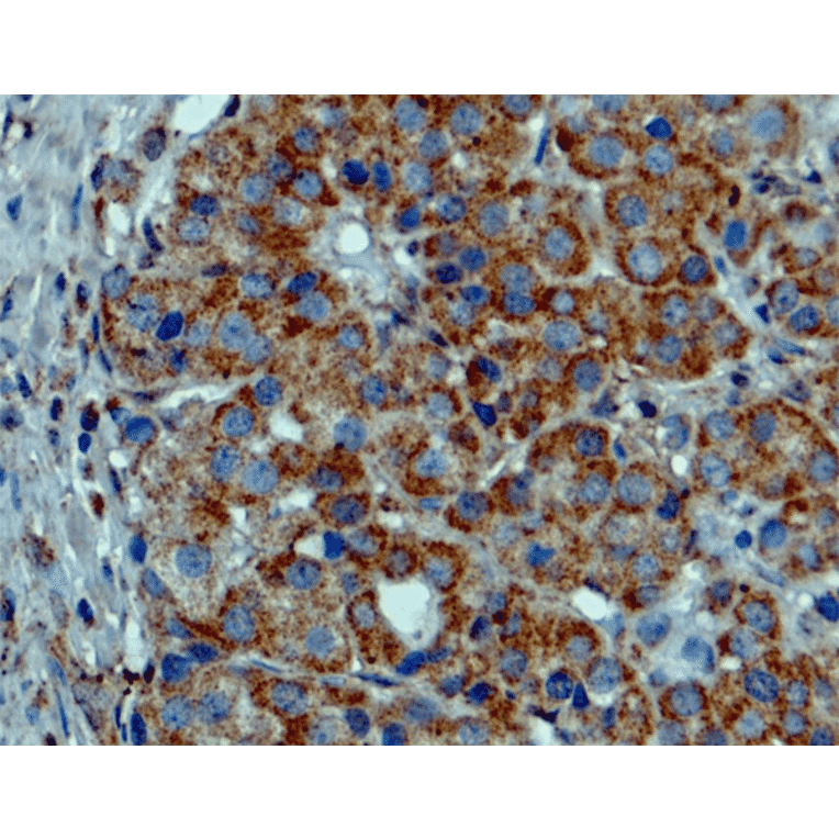 Immunohistochemistry - Anti-BRAF (mutated V600E) Antibody [RM8] (A121250) - Antibodies.com