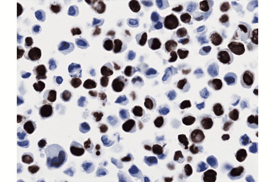 Immunohistochemistry - Anti-Histone H3 (K36M mutant) Antibody [RM193] (A121200) - Antibodies.com