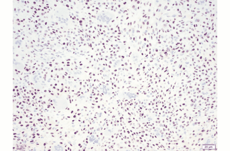Immunohistochemistry - Anti-Histone H3 (K36M mutant) Antibody [RM193] (A121297) - Antibodies.com