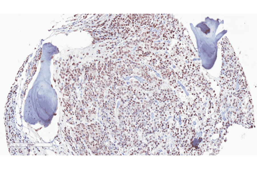 Immunohistochemistry - Anti-Androgen Receptor (AR-V7 specific) Antibody [RM7] (A121299) - Antibodies.com