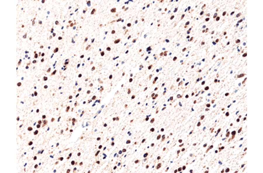 Immunohistochemistry - Anti-IDH1 (R132H mutant) Antibody [RM390] (A121203) - Antibodies.com
