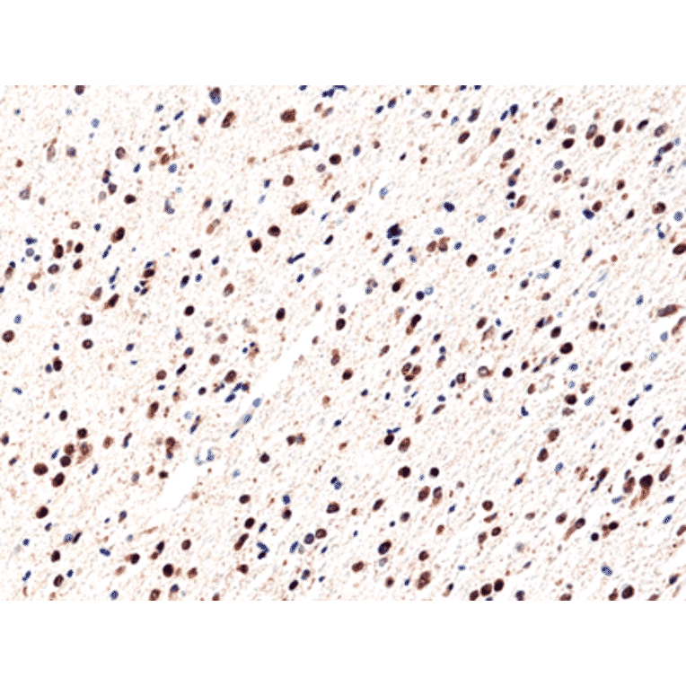 Immunohistochemistry - Anti-IDH1 (R132H mutant) Antibody [RM390] (A121203) - Antibodies.com