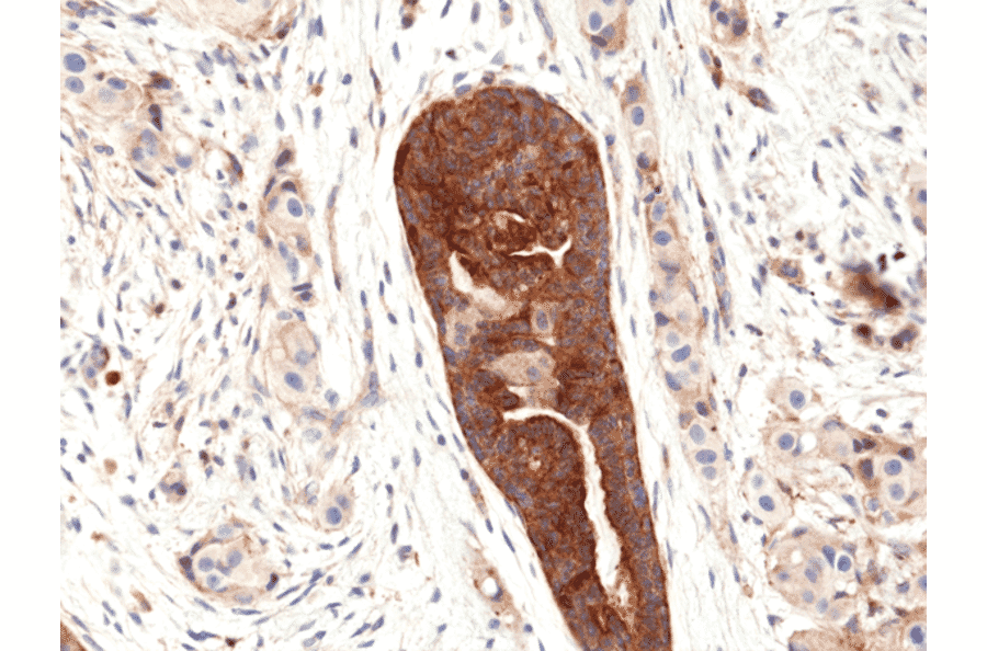 IHC of FFPE human breast cancer tissue stained with recombinant rabbit anti-VEGFA [R391] (A121422)