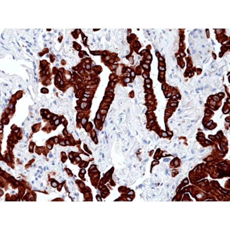 Immunohistochemistry - Anti-Cytokeratin 7 Antibody [RM416] (A121429) - Antibodies.com