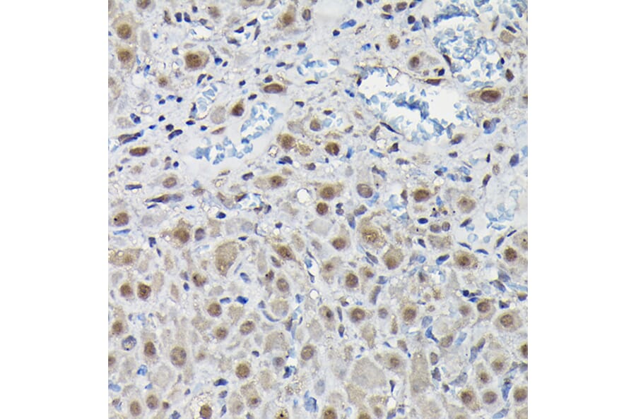 Immunohistochemistry - Anti-PFKFB3 Antibody (A15442) - Antibodies.com
