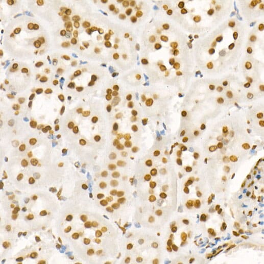 Immunohistochemistry of paraffin-embedded human gastric cancer using Anti-Histone H4 (acetyl K8) Antibody (A7258) at dilution of 1:100 (40x lens).