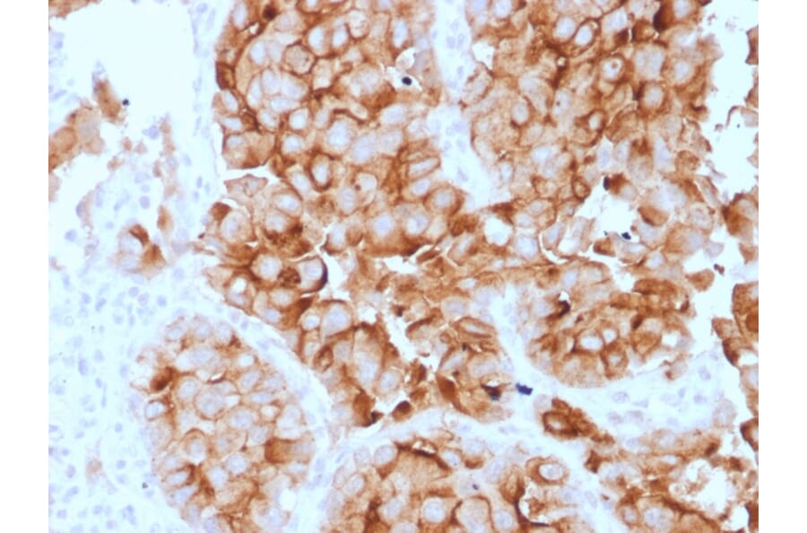 Immunohistochemistry - Anti-Mesothelin Antibody [SPM143] (A248079) - Antibodies.com