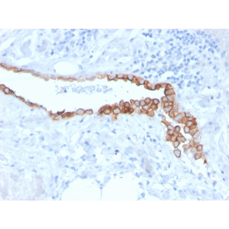Immunohistochemistry - Anti-Mesothelin Antibody [MSLN/3384] (A248080) - Antibodies.com