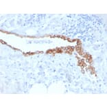 Immunohistochemistry - Anti-Mesothelin Antibody [MSLN/3384] (A248080) - Antibodies.com