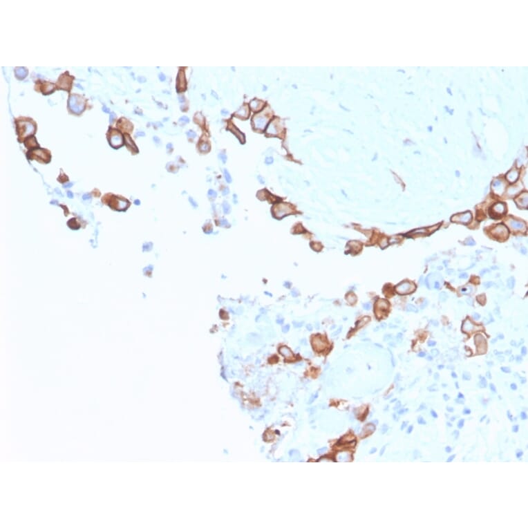 Immunohistochemistry - Anti-Mesothelin Antibody [MSLN/3387] (A248082) - Antibodies.com