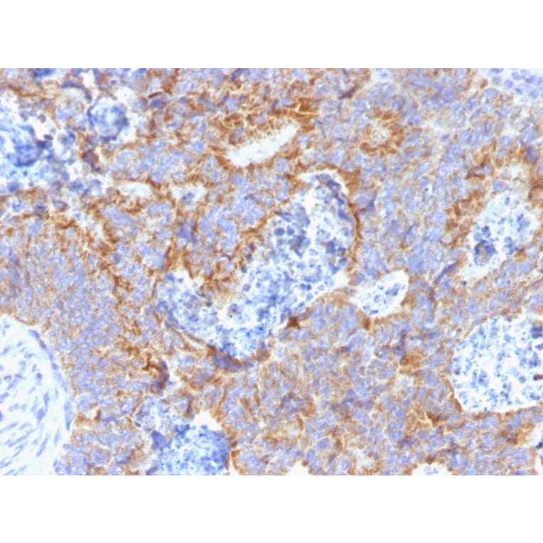 Immunohistochemistry - Anti-Carcinoembryonic Antigen Antibody [C66/1291] (A248122) - Antibodies.com