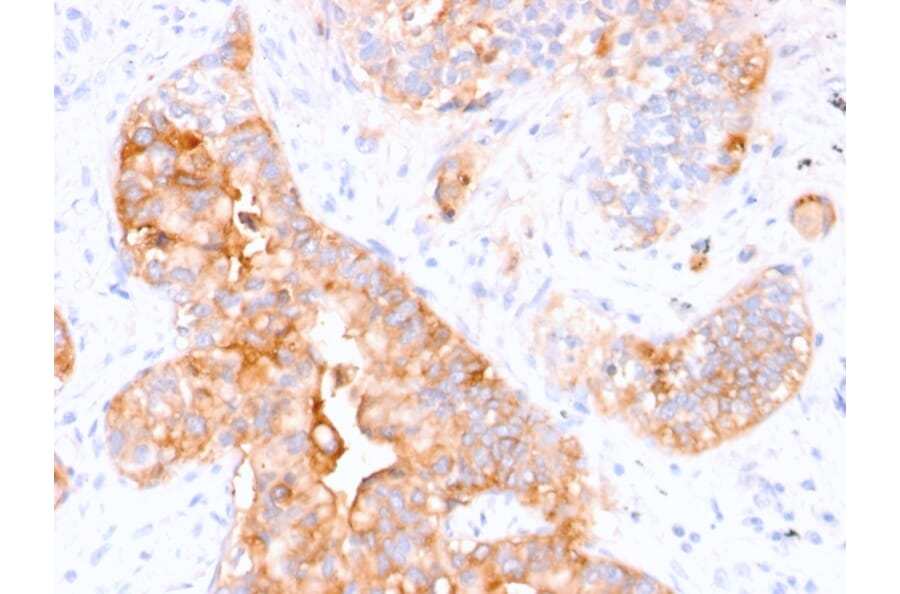 Immunohistochemistry - Anti-Carcinoembryonic Antigen Antibody [CEA31] (A248132) - Antibodies.com