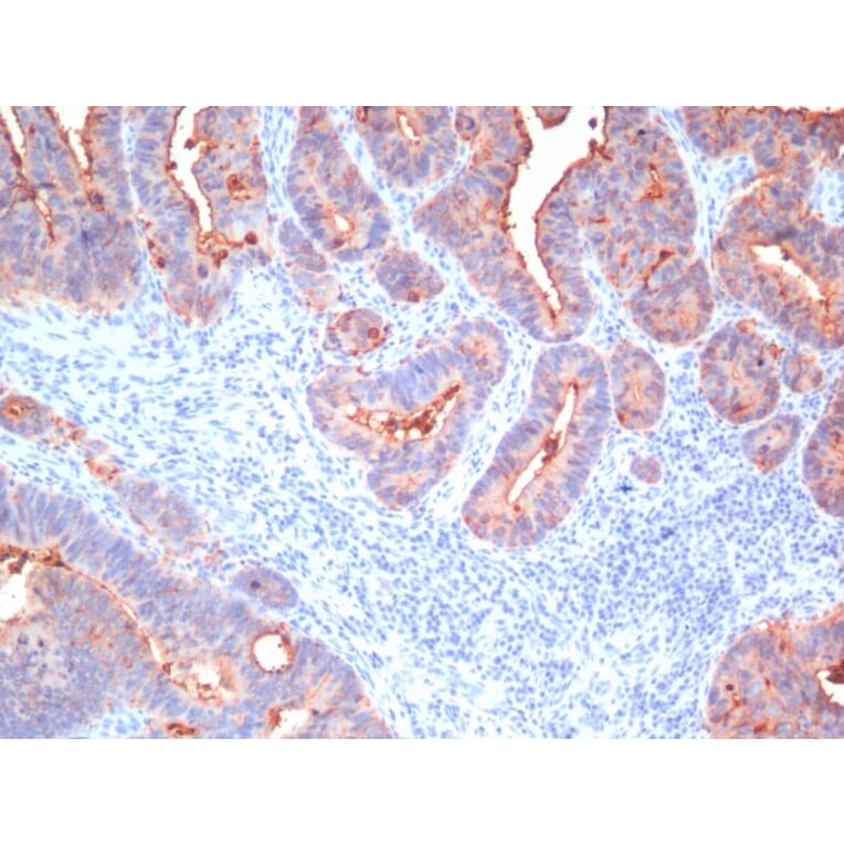 Immunohistochemistry - Anti-Carcinoembryonic Antigen Antibody [Cocktail PAN-CEA] (A248137) - Antibodies.com