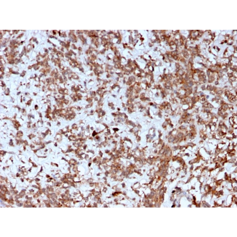 Immunohistochemistry - Anti-Cathepsin K Antibody [CTSK/2792] (A248310) - Antibodies.com