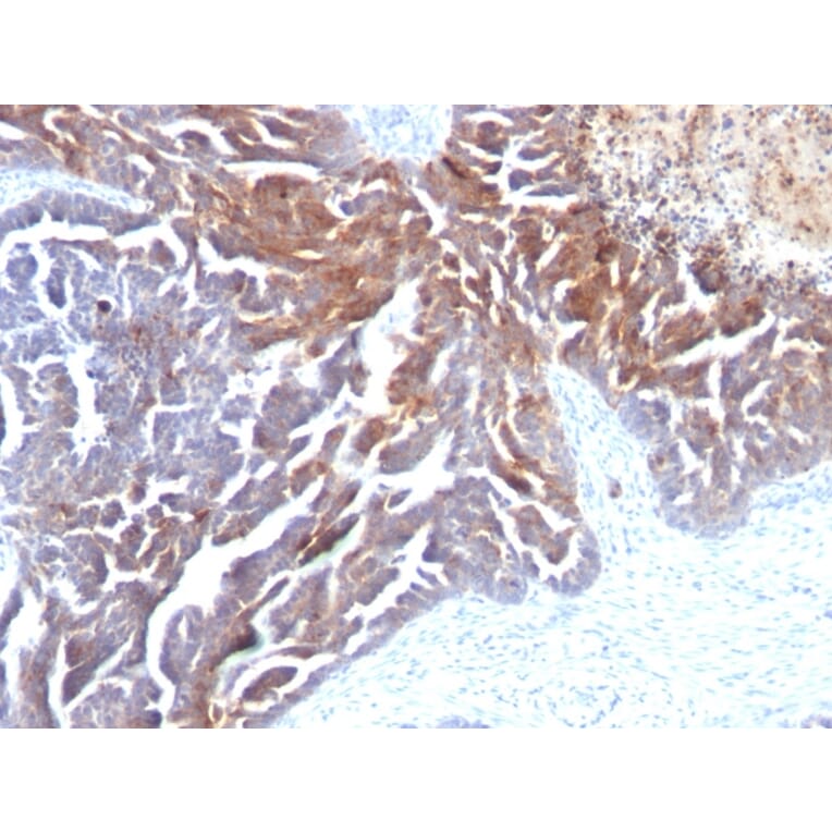 Immunohistochemistry - Anti-TAG72 Antibody [CC49] (A248357) - Antibodies.com