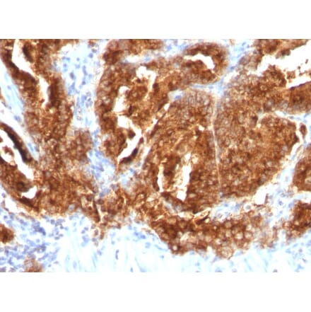 Immunohistochemistry - Anti-TAG72 Antibody [CA72/733] (A248360) - Antibodies.com